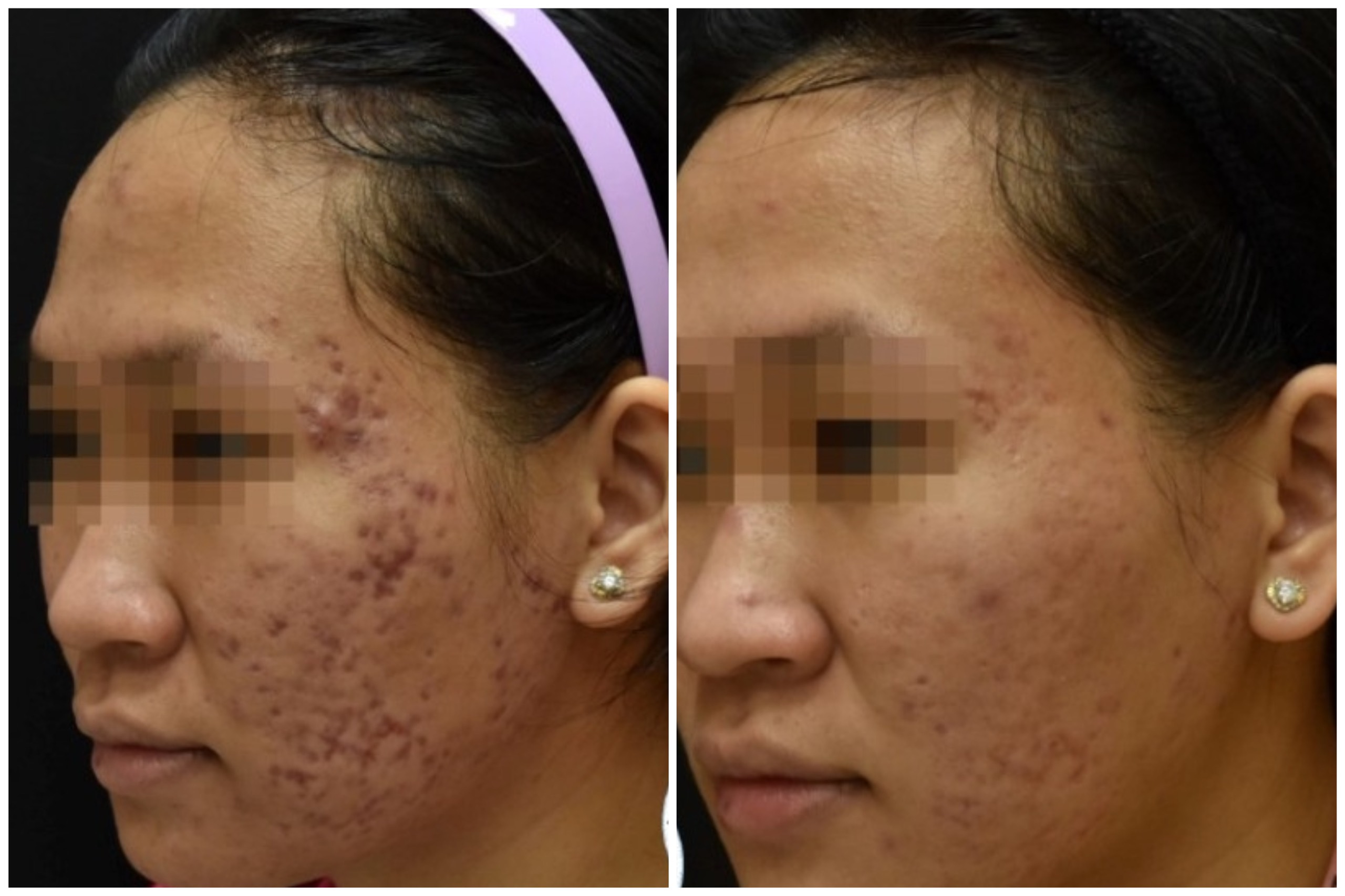 Sẹo hồng ban sau mụn điều trị với laser. Ảnh: BVCC