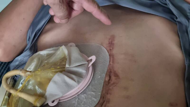 Thanh niên 28 tuổi ở thị trấn Long Hồ đã phải phẫu thuật 6 lần vì ruột bị hoại tử với số tiền trên 100 triệu đồng. Ảnh: Hoàng Lộc
