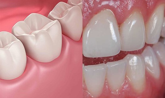 Tụt nướu răng diễn ra từ từ, xảy ra khi mô nướu tách ra khỏi răng. Đồ họa: Huỳnh Phương