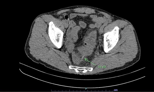 Hình ảnh chụp cắt lớp vi tính cho thấy dị vật đâm thủng đại tràng người bệnh. Ảnh: BVCC