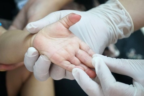 Khám điều trị cho trẻ em bị tay chân miệng (hình minh họa). Ảnh: Phan Tuấn