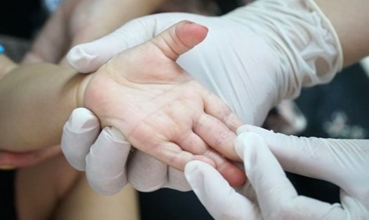 Khám điều trị cho trẻ em bị tay chân miệng (hình minh họa). Ảnh: Phan Tuấn