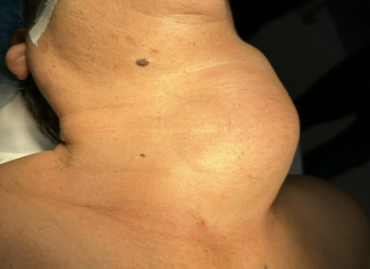 Phần bướu giáp lớn trước khi phẫu thuật. Ảnh: BVCC