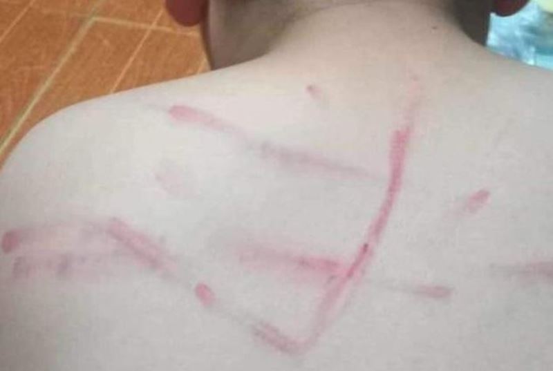 Những vết bầm tím trên lưng của nam sinh sau khi bị cô giáo dùng roi đánh. Ảnh: Người nhà phản ánh và đăng tải lên mạng xã hội.