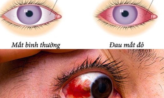Những điều cần biết về dịch đau mắt đỏ khi diễn biến ngày càng phức tạp. Đồ họa: Hương Giang