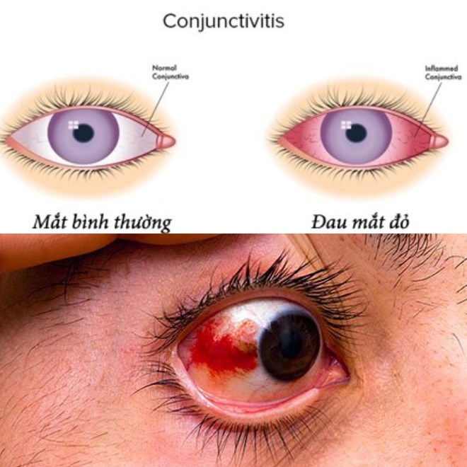Bác sĩ khuyến cáo không được đắp các loại lá vào mắt khi bị đau mắt đỏ