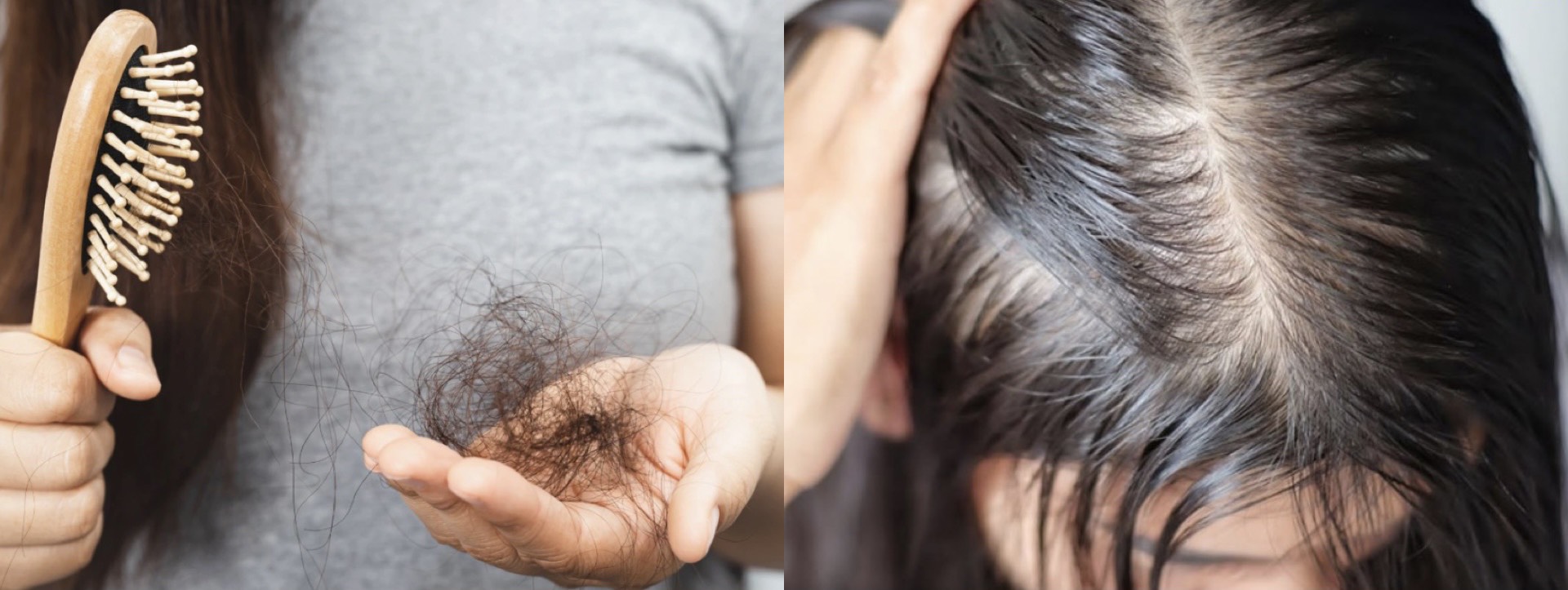 Rụng tóc ở nam giới do đâu? 11 nguyên nhân rụng tóc ở nam
