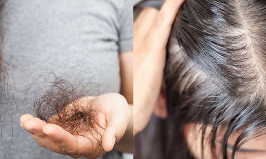 Nguyên nhân gây rụng tóc mỗi ngày. Đồ họa: Hương Giang