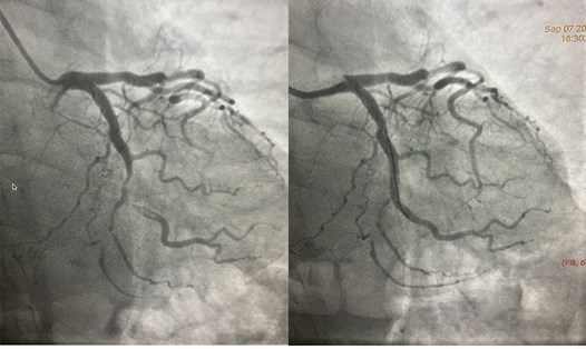 Hình ảnh chụp động mạch vành của người bệnh nhồi máu cơ tim trước và sau can thiệp. Ảnhh: BVCC