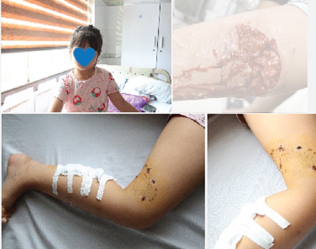 Vết thương bị chó cắn sau khi được xử lí nhiễm trùng. Ảnh: BVCC