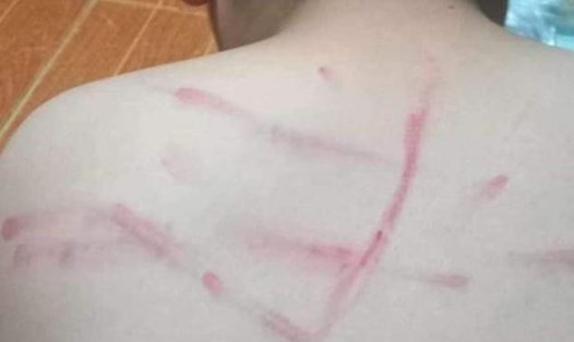 Học sinh lớp 4 ở Thanh Hóa bị cô giáo đánh bầm tím lưng vì không làm bài tập. Ảnh: LĐO