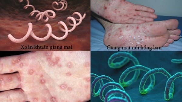 Bệnh nhân mắc giang mai có nguy cơ cao mắc các bệnh lây truyền qua đường tình dục khác, trong đó có HIV. Ảnh: Bệnh viện Phụ sản Hà Nội