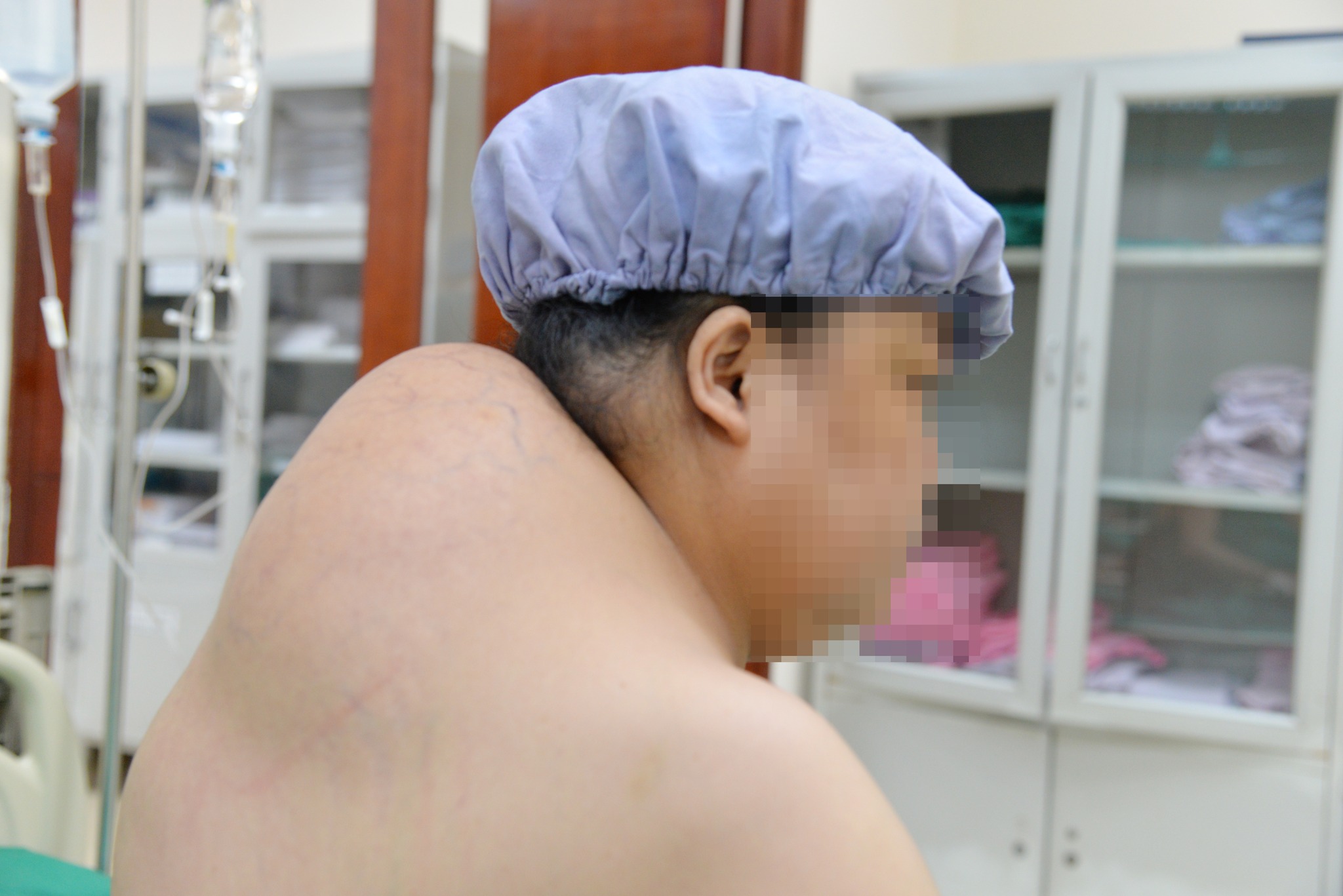 Khối u mỡ trước khi phẫu thuật. Ảnh: BVCC