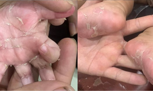Bong vảy ở lòng bàn tay, bàn chân là biểu hiện của bệnh giang mai bẩm sinh. Ảnh: BVCC