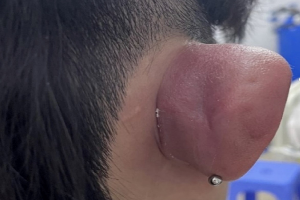 Bệnh nhân bị hoại tử sụn sau khi bấm liên tiếp 4 -5 lỗ tai. Ảnh: Bệnh viện cung cấp