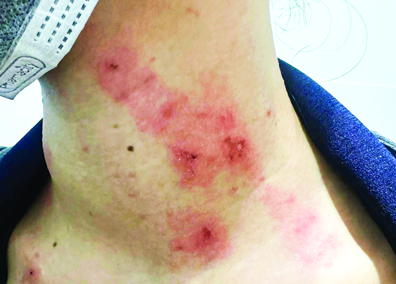 Số lượng người bệnh đến khám ở các bệnh viện TPHCM do kiến ba khoang tăng vọt. Ảnh: Hạ Mây