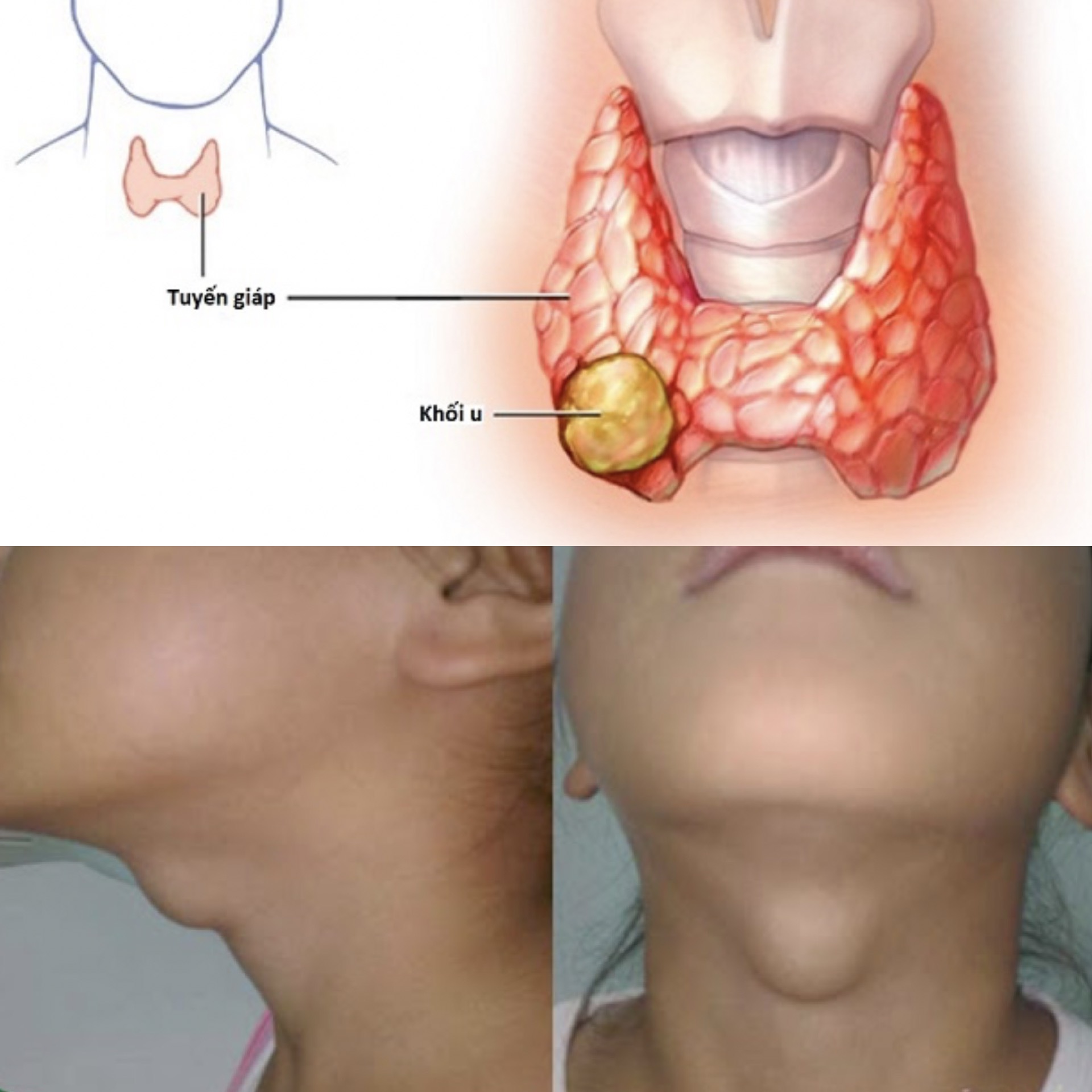 1. Tổng Quan về Khối U Tuyến Giáp