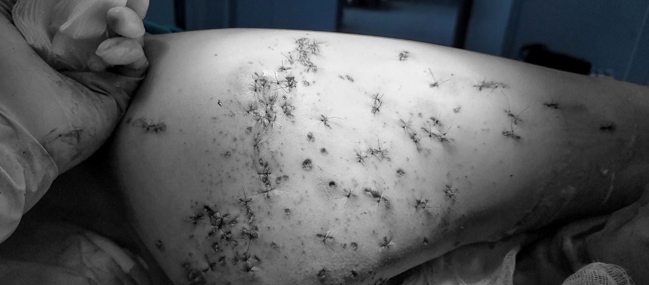 Hàng trăm vết thương trên cơ thể người bệnh do pháo nổ. Ảnh: Hà Linh