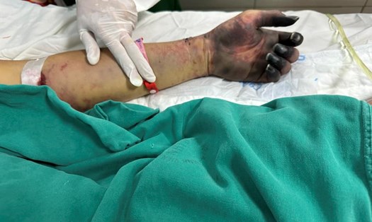 Bệnh nhân bị hoại tử toàn bộ chân và các ngón tay. Ảnh: Bệnh viện cung cấp