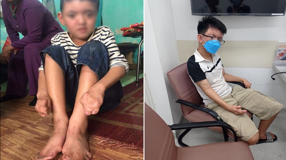 Những bệnh nhi không may mắc dị tật bàn tay, bàn chân. Ảnh: Ái Vy