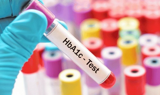 
Người trên 50 tuổi nên làm các xét nghiệm, trong đó có xét nghiệm tiểu đường (xét nghiệm HbA1c phản ánh lượng glucose trong máu gắn với hemoglobin trong ba tháng qua) Ảnh minh hoạ: Sưu tầm
