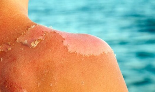 Làn da cháy nắng là một trong những nguyên nhân gây sụt giảm collagen. Ảnh: Pixabay