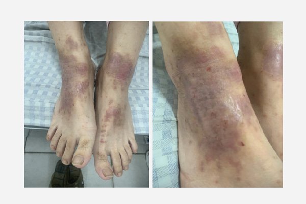 Bệnh nhân bị viêm da cơ địa sau khi tắm bằng thuốc nam. Ảnh: BVCC