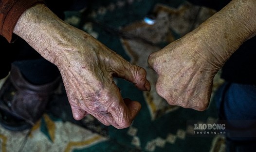 Đôi bàn tay bị tổn thương của một người cao tuổi mắc bệnh phong. Ảnh: Tạ Quang