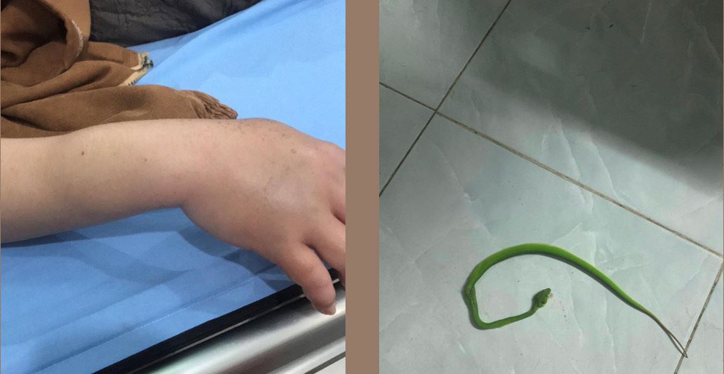Một trường hợp bị rắn lục cắn phải nhập viện tại Khánh Hòa. Ảnh: Phương Linh