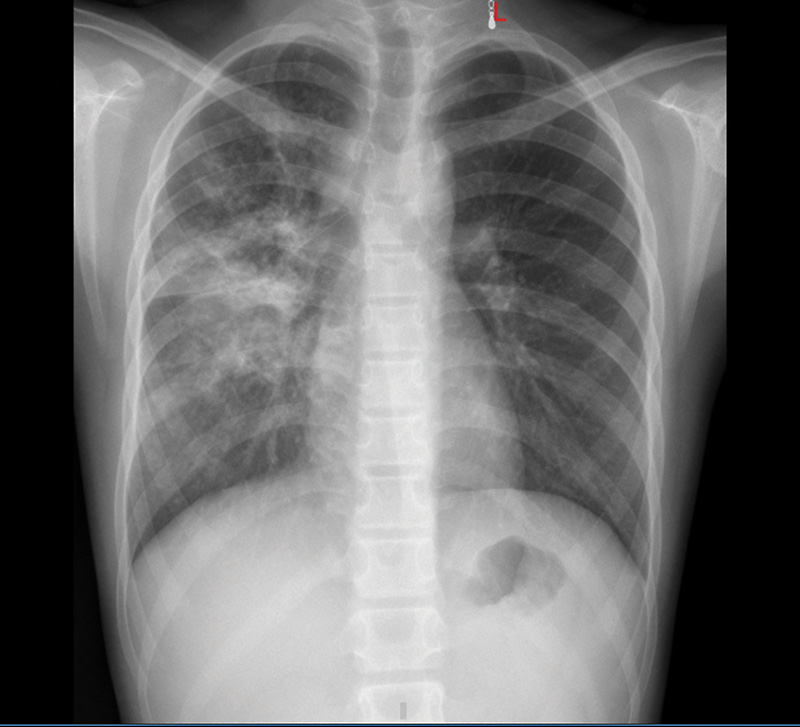 Hình ảnh chụp X-quang phổi của trẻ sau 10 ngày điều trị. Ảnh: Nguyễn Hà