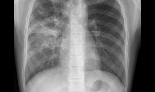 Hình ảnh chụp X-quang phổi của trẻ sau 10 ngày điều trị. Ảnh: Nguyễn Hà