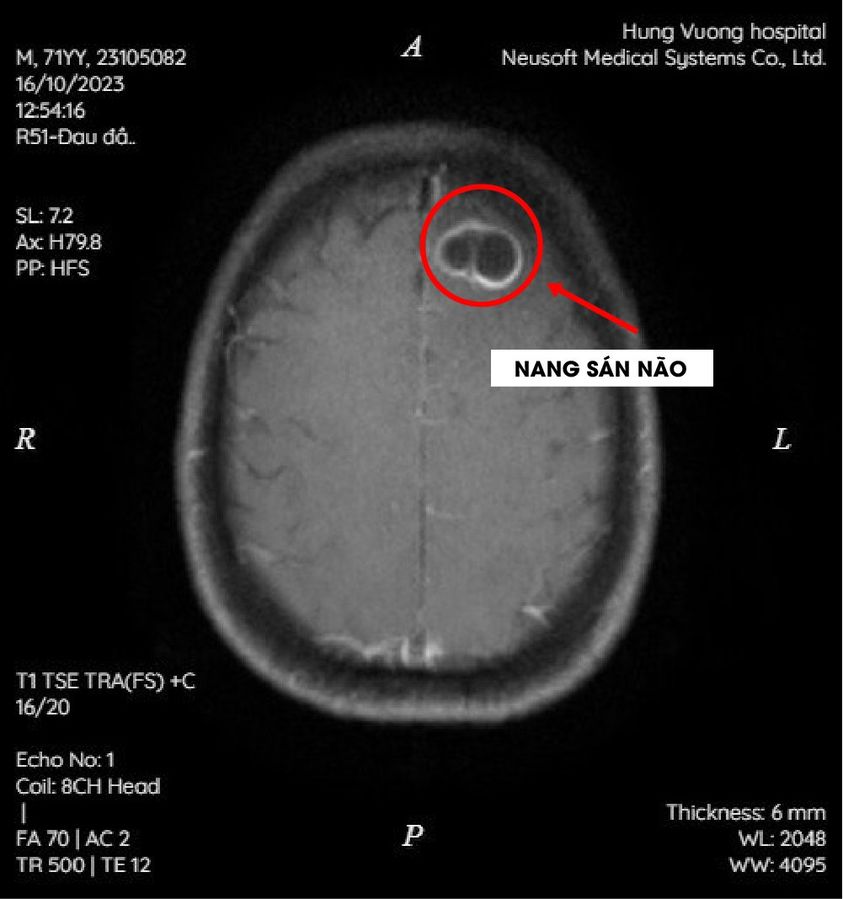 Hình ảnh nang sán não trên phim chụp MRI sọ não. Ảnh: BVCC