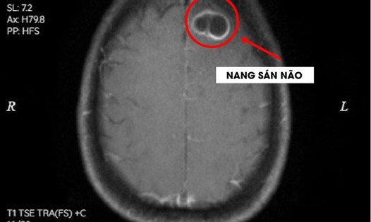 Hình ảnh nang sán não trên phim chụp MRI sọ não. Ảnh: BVCC