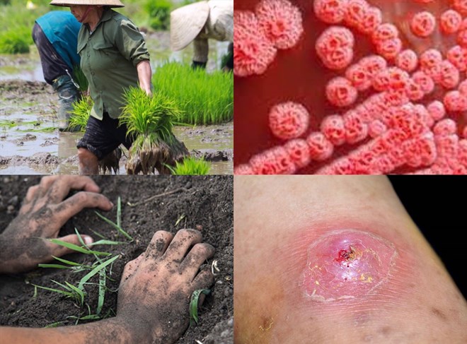 Vi khuẩn gây bệnh Whitmore sống trong bùn đất, nước bị ô nhiễm. Ảnh đồ họa: Hương Giang