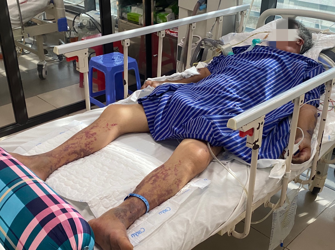 Bệnh nhân mắc liên cầu lợn nguy kịch đang được điều trị tại Bệnh viện Đa khoa tỉnh Lạng Sơn. Ảnh: BVCC