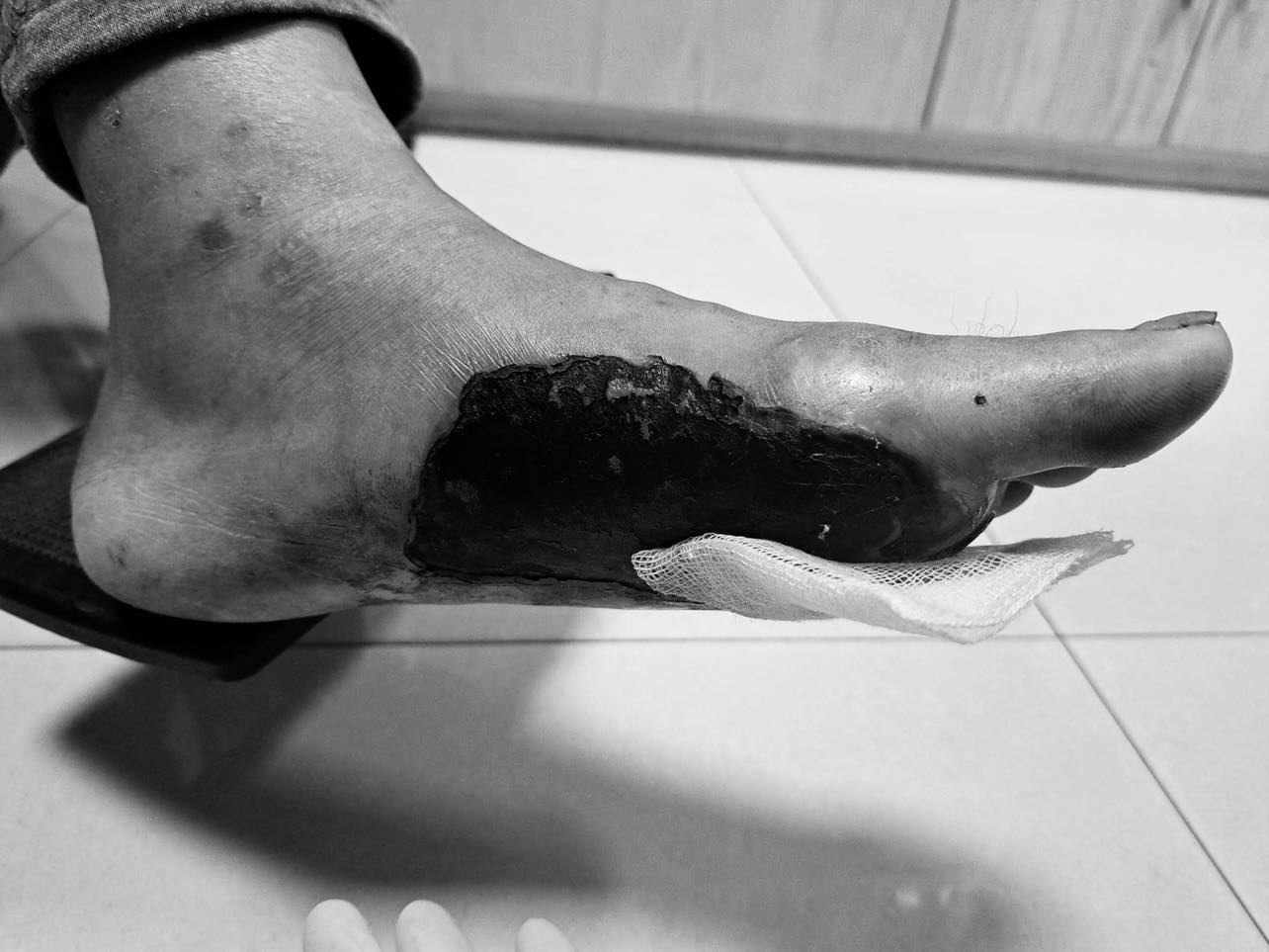 Bàn chân bệnh nhân đái tháo đường bị loét. Ảnh: BVCC