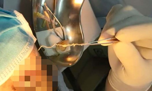Các bác sĩ Khoa Mắt, Bệnh viện Việt Nam - Thụy Điển Uông Bí gắp được 1 con giun dài 10 cm trong mắt một nữ người bệnh. Ảnh: Bệnh viện cung cấp