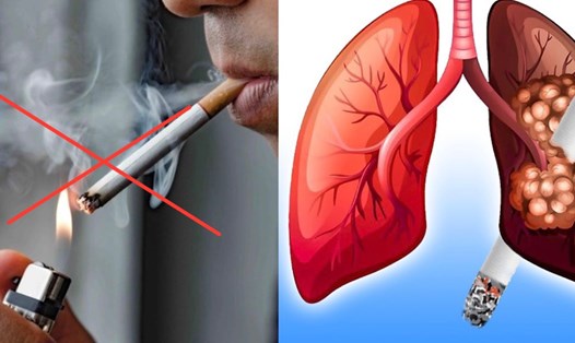 Hút thuốc là nguyên nhân chính gây ra căn bệnh ung thư phổi. Đồ họa: Hương Giang