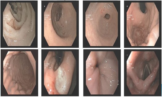 Hình ảnh nội soi dạ dày của bệnh nhân có ổ loét và nhiều giun móc ký sinh trong hành tá tràng, tá tràng. Ảnh: BVCC