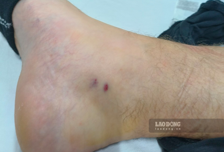 Du khách bị rắn cắn hiện sức khỏe đã ổn định. Ảnh: Phòng khám S.O.S