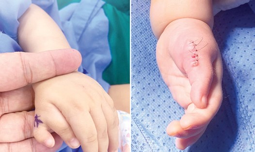 Phẫu thuật loại bỏ ngón tay thừa cho bệnh nhi. Ảnh: Bệnh viện Đa khoa Tâm Anh TPHCM