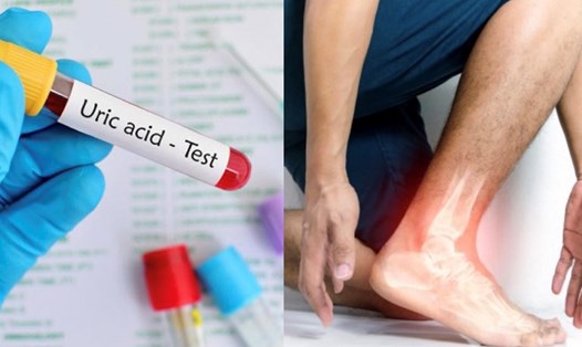 Axit uric là một trong những nguyên nhân gây bệnh gout. Đồ họa: Hương Giang