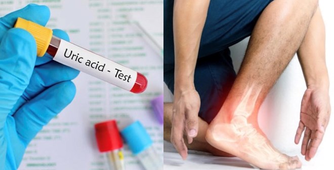 Tăng hay giảm axit uric cũng có thể là nguyên nhân gây bệnh gout