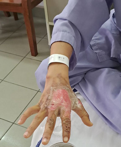 Vết bỏng do trẻ nghịch diêm. Ảnh: BVCC