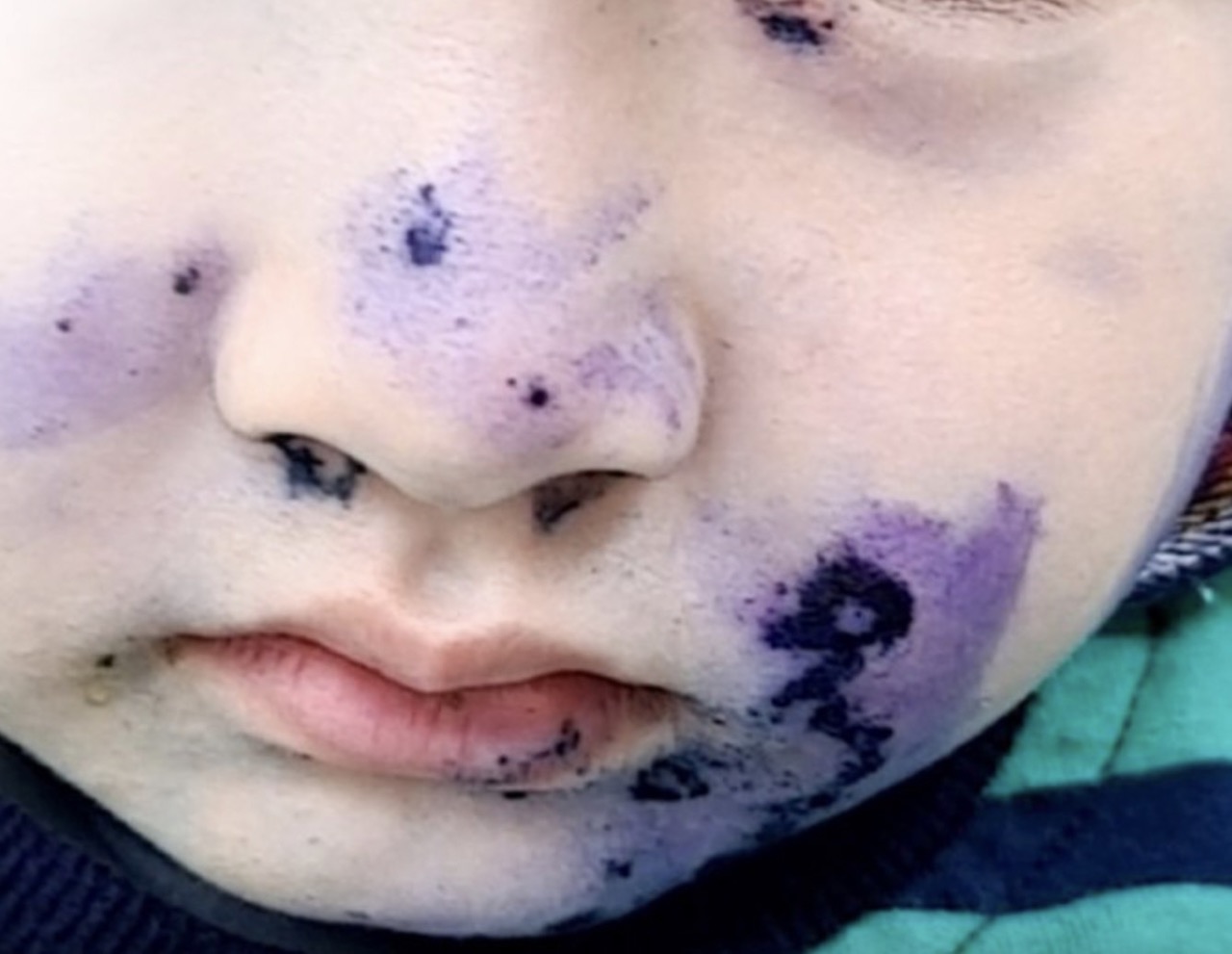 Bệnh chốc lan khắp cơ thể bệnh nhi. Ảnh: ANH THƯ 