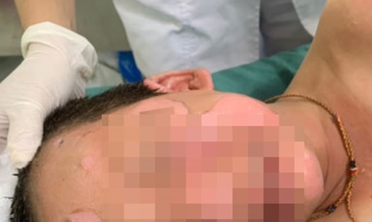 Một bệnh nhi 4 tuổi tại Quảng Nam phải nhập viện điều trị trong tình trạng bỏng nặng vùng mặt, đầu và cổ.