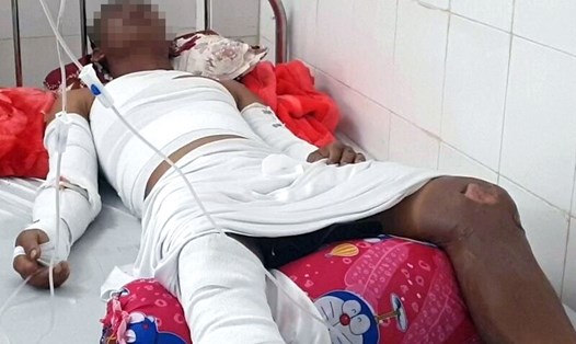 Nạn nhân đang nằm điều trị tại Bệnh viện Đa khoa tỉnh Cà Mau sau vụ nổ ghe. Ảnh: Nhật Hồ