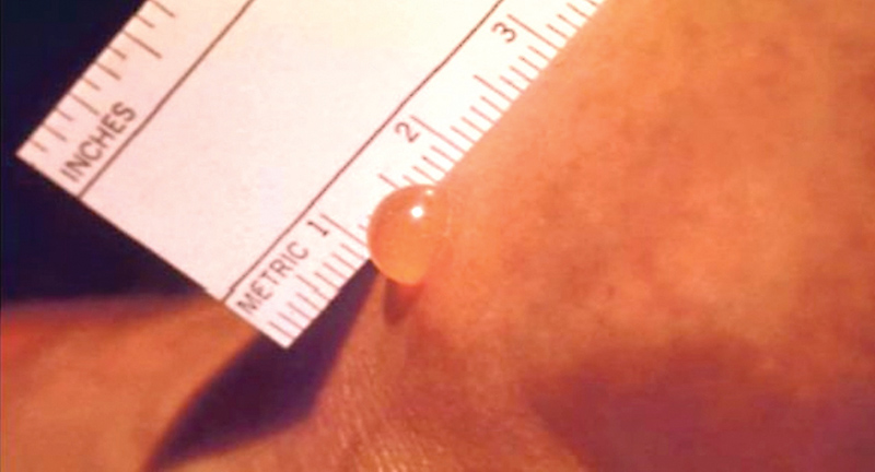 Hình ảnh nốt mò đốt trên người bệnh sốt mò. Ảnh: Bệnh viện Nhi Đồng 1