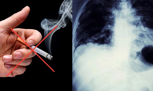 Thuốc lá là nguyên nhân chính gây ra ung thư phổi. Đồ họa: Hương Giang