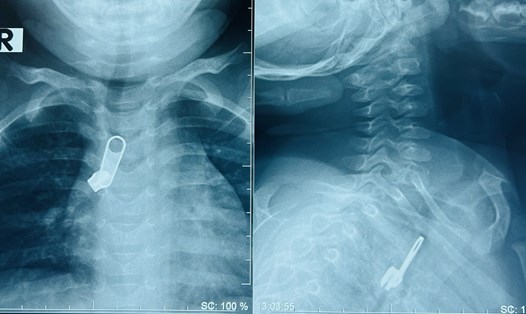 Hình dị vật trên phim X-quang thẳng, nghiêng. Ảnh: Bệnh viện Nhi đồng 1.
